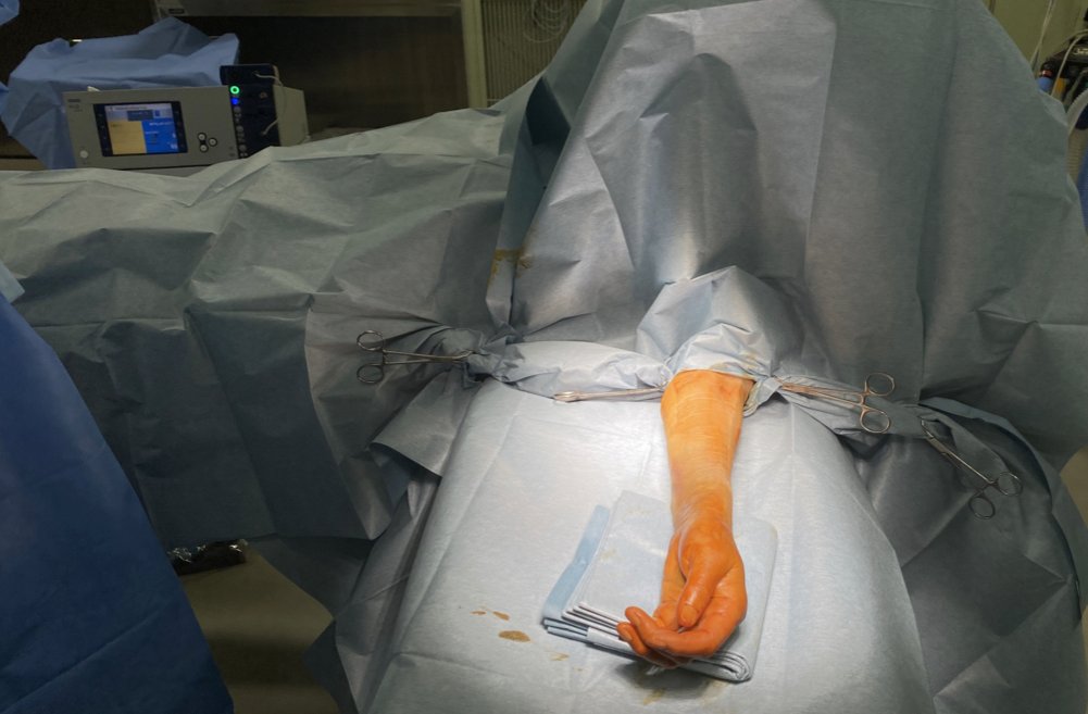 手首手術前に清潔な布を被せ終わった状態（手術開始前の状態）