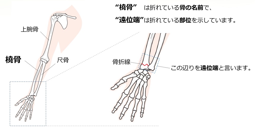 手首の骨折（橈骨遠位端骨折）の図解