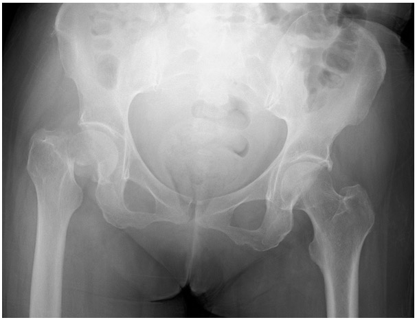 大腿骨頸部骨折のレントゲン写真