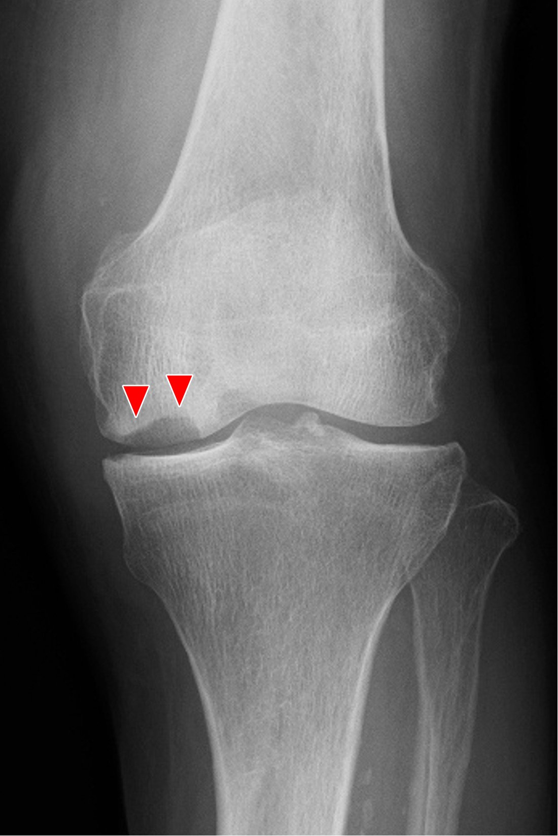 膝関節骨壊死症のレントゲン写真