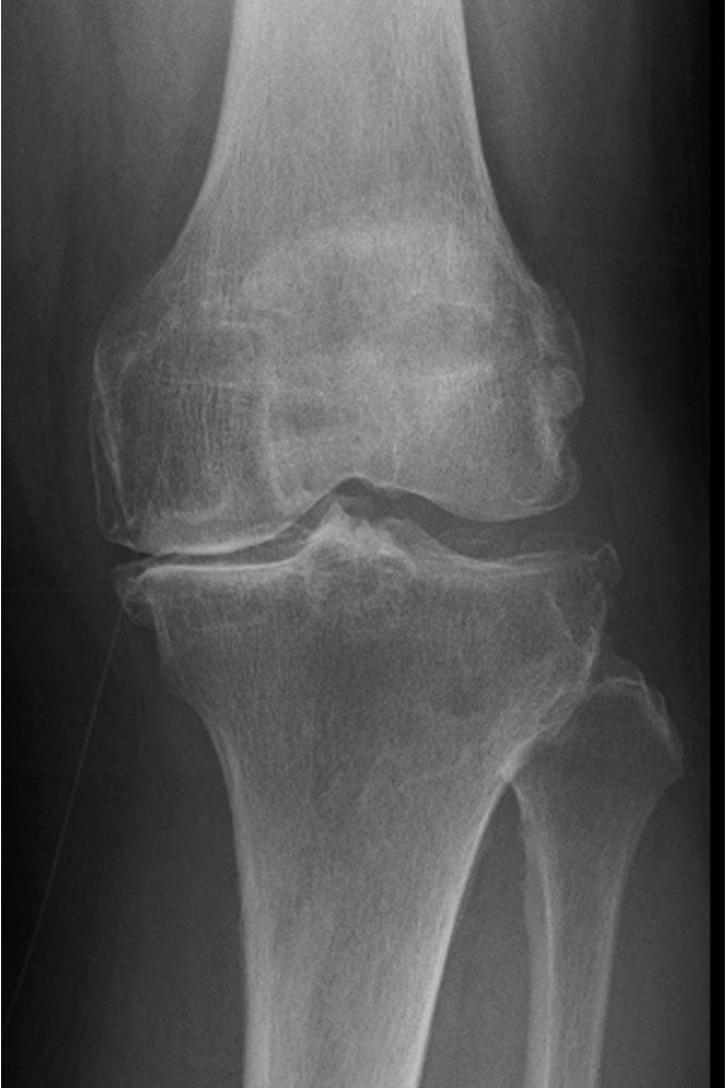 人工膝関節置換術の手術前レントゲン写真