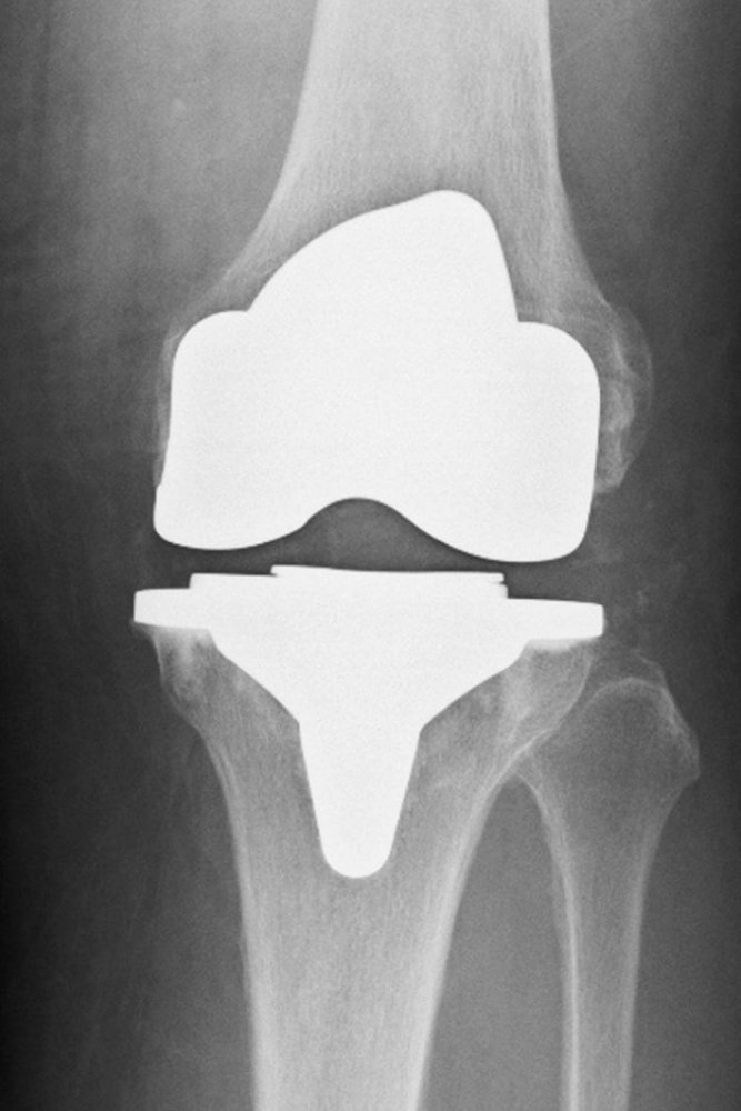 人工膝関節置換術の手術後レントゲン写真