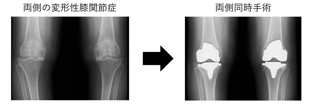 人工膝関節について - 人工膝関節置換術 | 千葉市立青葉病院