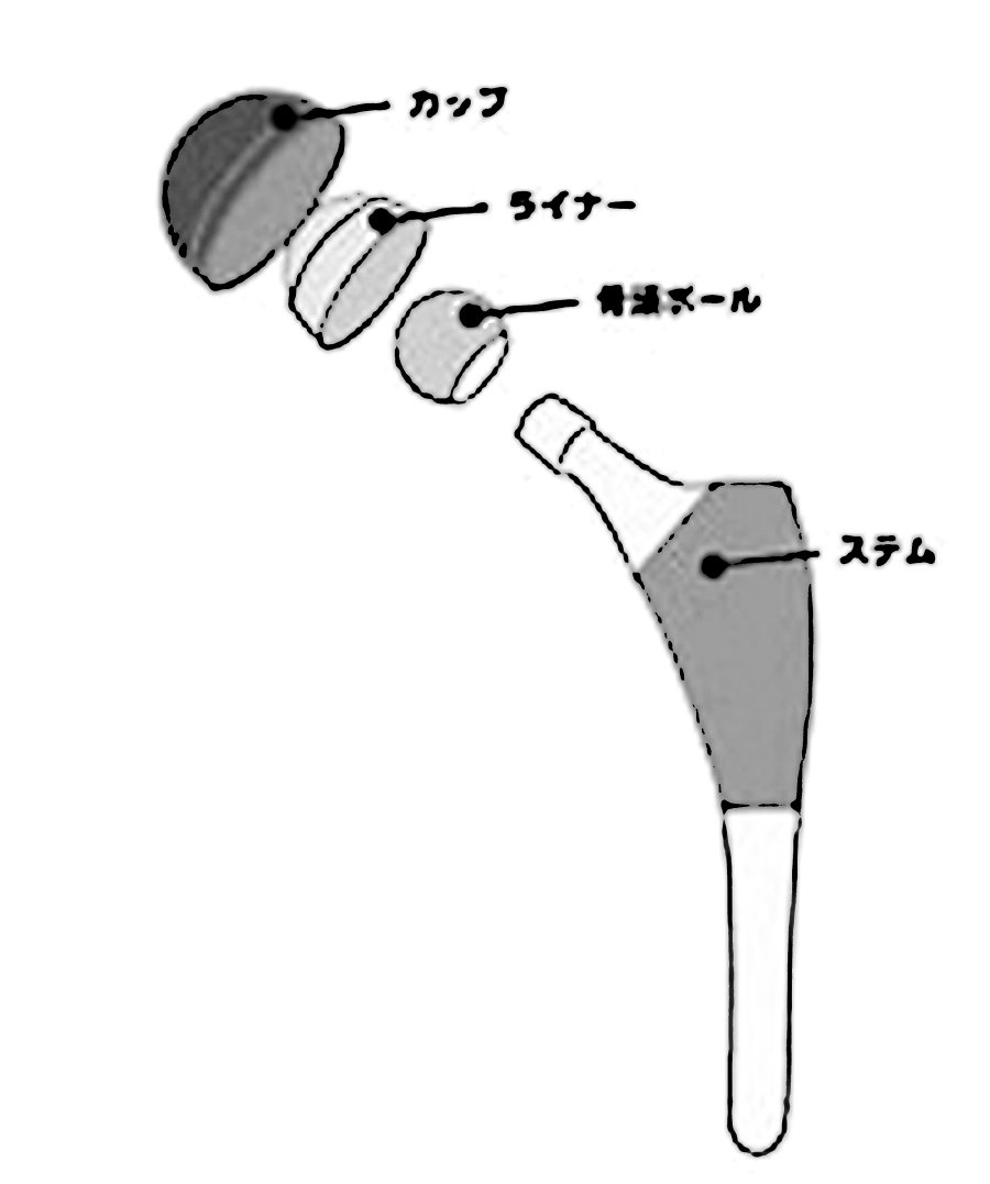 人工股関節インプラントのイメージ画像