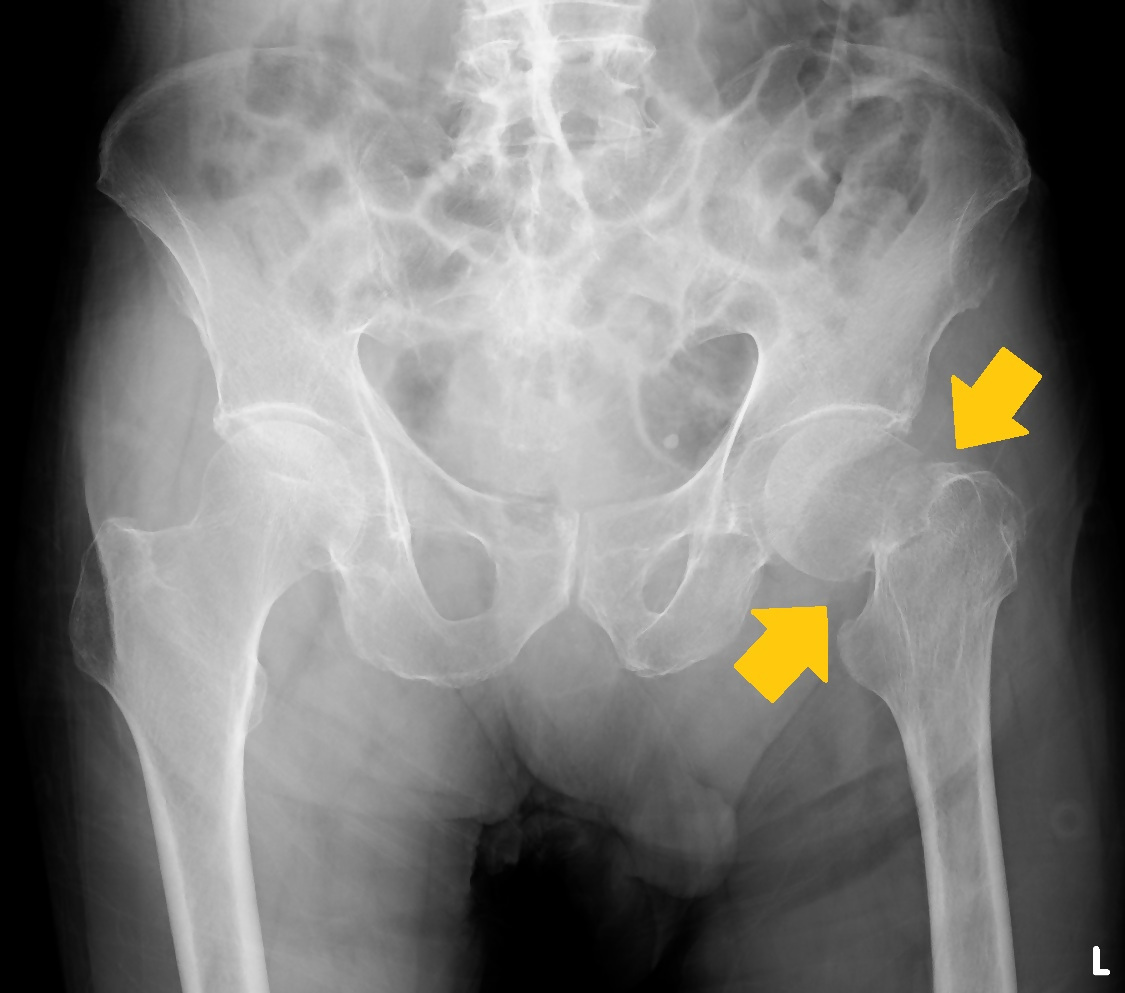海浜病院 大腿骨頚部骨折のレントゲン写真