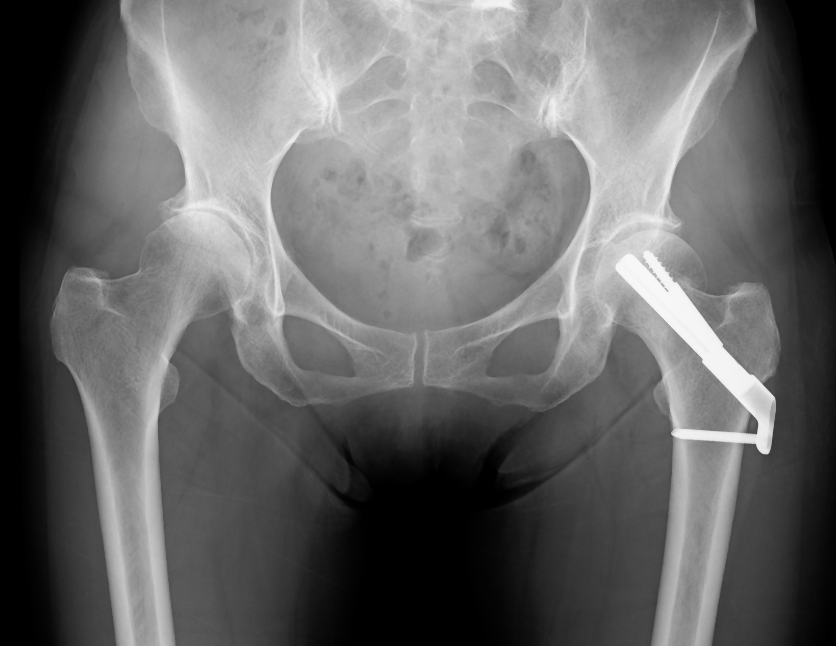 海浜病院 大腿骨接合術（固定術）のレントゲン写真