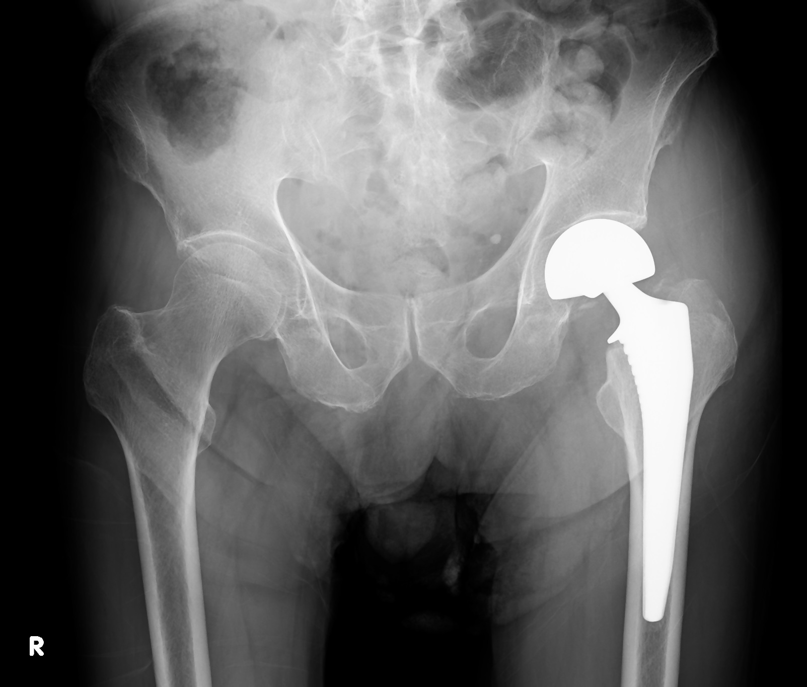 海浜病院 人工骨頭置換術のレントゲン写真
